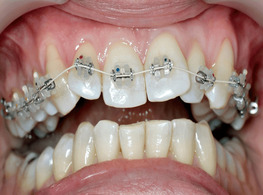 Современные способы выравнивания зубов