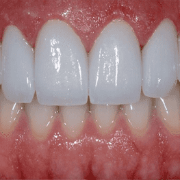 После восстановления эстетики зубов