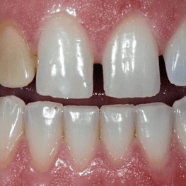 До восстановления эстетики зубов