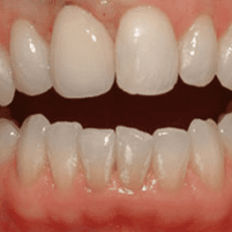После имплантации переднего зуба