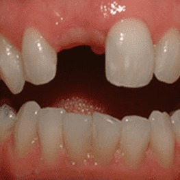 До имплантации переднего зуба