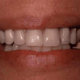 После Функциональной реабилитации зубов